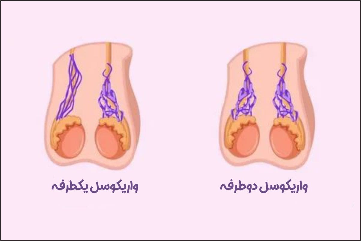 عوارض واریکوسل بیضه چپ / بیضه راست