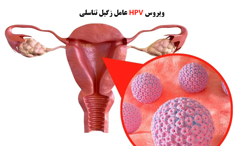 ویروس HPV زگیل تناسلی