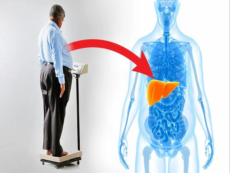کاهش وزن بدون دلیل از عوامل کبد چرب است؟