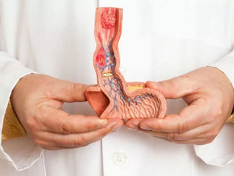 تشخیص سرطان بیضه