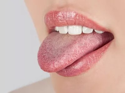 برفک دهانی ایدز