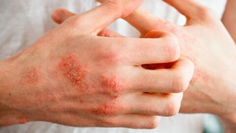 مشکلات پوستی کرونا