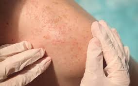 فرآیند غربالگری و مدیریت کهیر مزمن مشکوک به بدخیمی