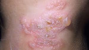 بیماری‌های مقاربتی (STDs) + راه های پیشگیری