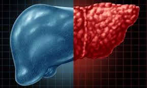 کبد چرب و فریتین بالا