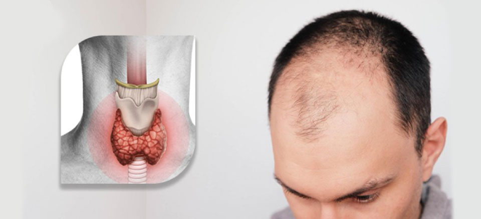تاثیر تیروئید بر ریزش مو